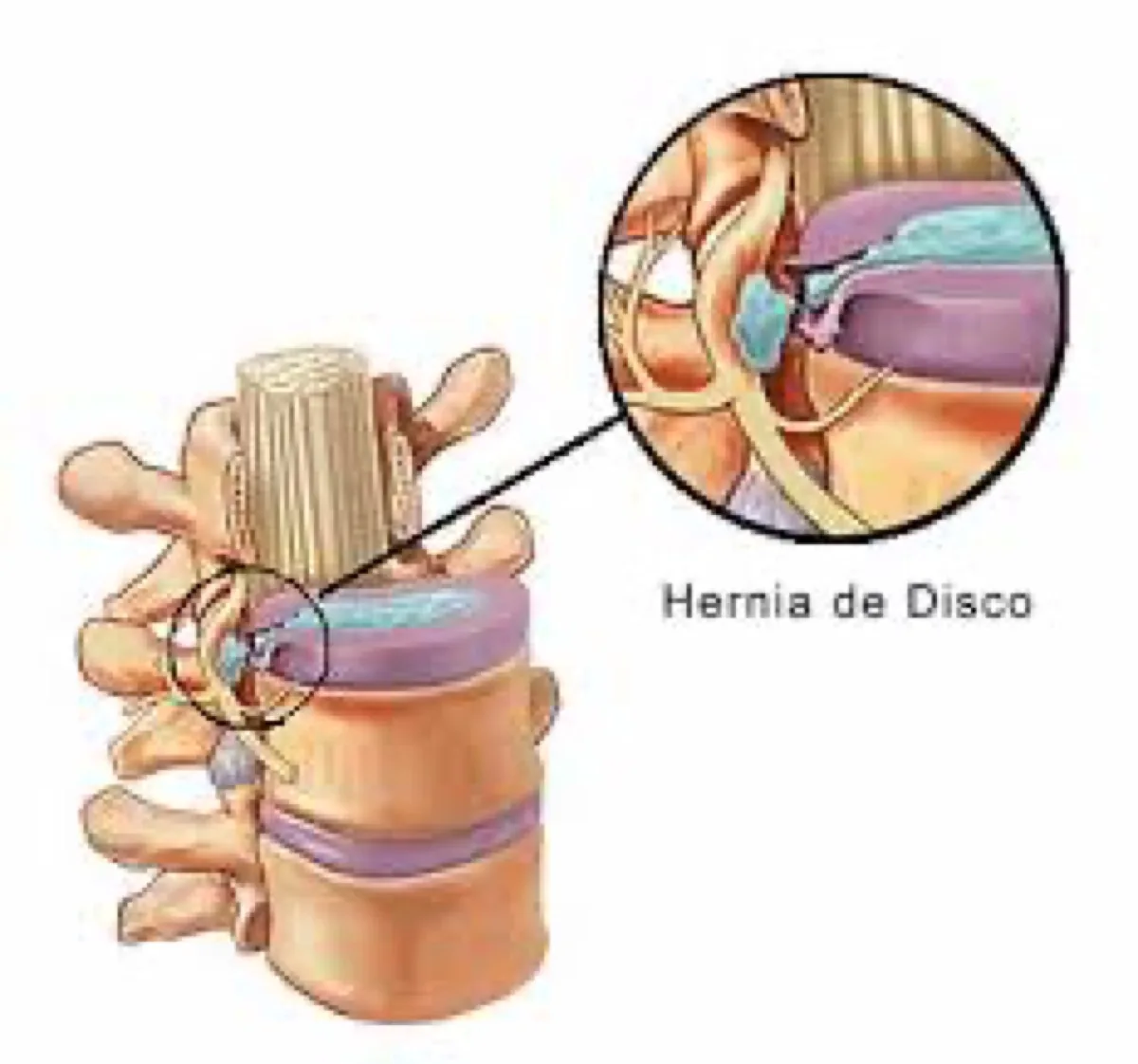 Rehabilitación · Tengo dolor de espalda que se va a la pierna ¿es ciática? ¿me tengo que operar? Parte 1